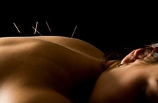 Trigger Point Dry Needling - Seacoast Sports Injuries