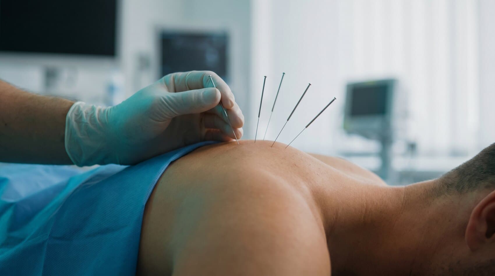 Trigger Point Dry Needling